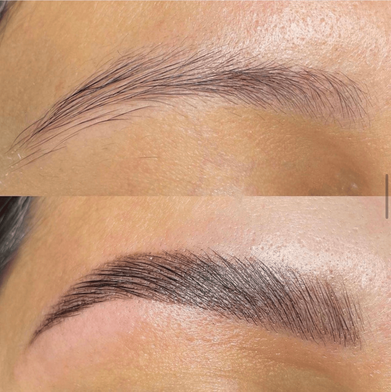 Brow Lift